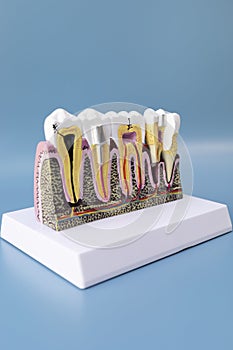 Dental Tooth Implant, Bridge Or Crown Model On Blue Background, Copy Space. Dummy Mockup