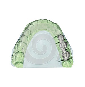 Dental tooth implant plaster pattern with metal bridge isolated