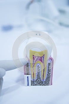 Dental tooth model cast showing decay enamel roots