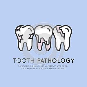 Dental Tooth Pathology and Decay