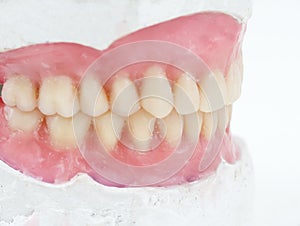 dental total wax prosthesis