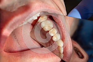 Dental treatment in dental clinic. Rotten carious tooth macro. Treatment endodontic canals photo