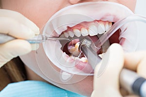 Dental treatment close-up