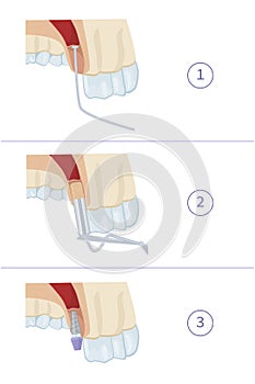 Dental treatment. Closed sinus lift. Dental services. Vector illustration for dental textbooks