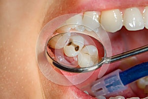 Dental treatment in dental clinic. Rotten carious tooth macro. T