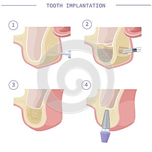 Dental treatment. Open sinus lift. Dental services. Vector illustration for dental textbooks. Step-by-step instruction
