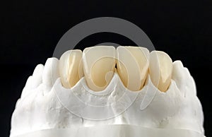 Dental veneers and crowns in the plaster model for treatment and new smile. Zirconia crowns with full porcelain. Dental Prosthetic photo