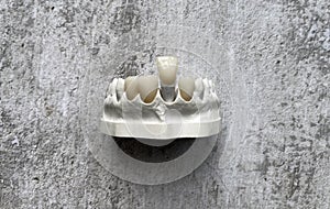 Dental veneers on a demountable model in the laboratory.