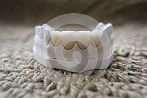 Dental veneers on a demountable plaster model