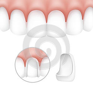 Dental veneers on human teeth