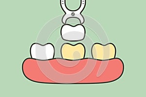 Dental veneers installation procedure for tooth whiten