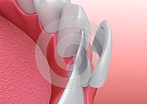 Dental Veneers: Porcelain Veneer installation Procedure