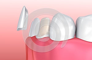 Dental Veneers: Porcelain Veneer installation Procedure