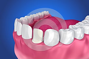 Dental Veneers: Porcelain Veneer installation Procedure.