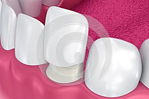 Dental Veneers: Porcelain Veneer installation Procedure