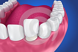 Dental Veneers: Porcelain Veneer installation Procedure.