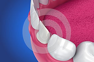 Dental Veneers: Porcelain Veneer installation Procedure.