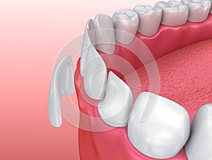 Dental Veneers: Porcelain Veneer installation Procedure