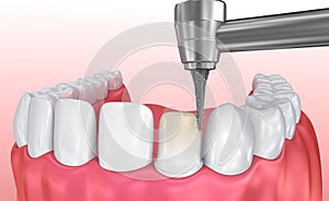 Dental Veneers: Porcelain Veneer installation Procedure. illustration photo