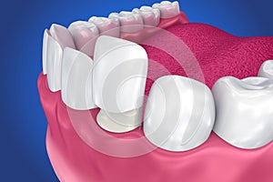 Dental Veneers: Porcelain Veneer installation Procedure. photo