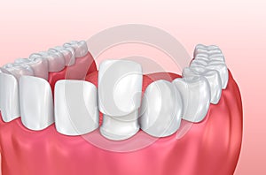 Dental Veneers: Porcelain Veneer installation Procedure.