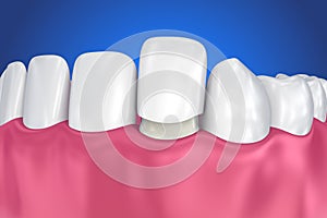 Dental Veneers: Porcelain Veneer installation Procedure.