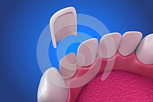 Dental Veneers: Porcelain Veneer installation Procedure. illustration