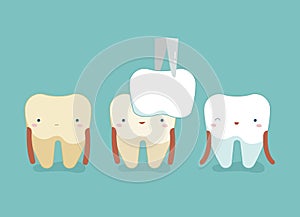 Dental Veneers ,teeth and tooth concept of dental photo