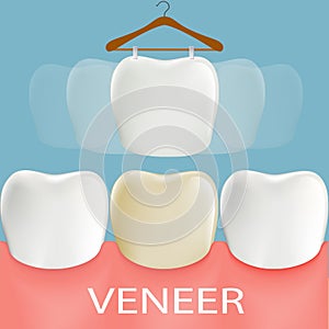 Dental veneers. Tooth anatomy.