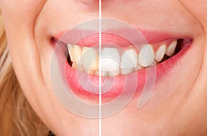 Zubná bieliaci prostriedok 