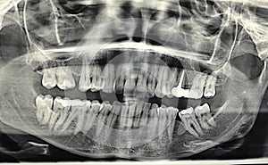 Dental X-ray