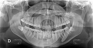 Dental x-ray