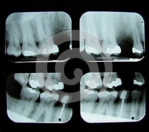 Dental x-rays