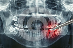 Dental xray