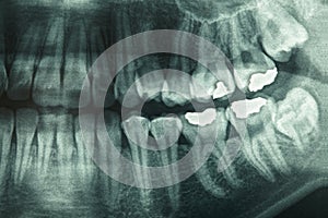 Dental xray