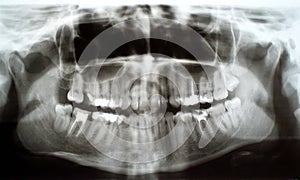 Dental xray