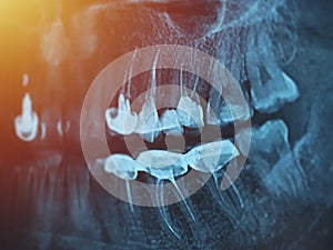 Dental xray for all teeth, side view