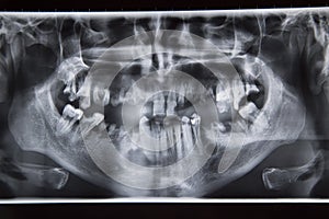 Dental xray with bad teeth