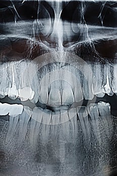 Dental Xray x-ray