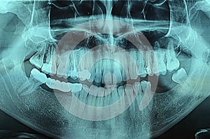 Dental Xray x-ray