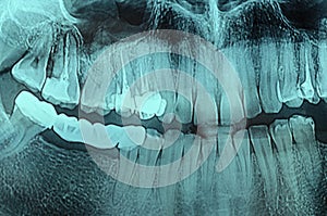 Dental Xray x-ray