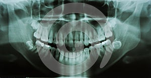 Dental Xray (x-ray)