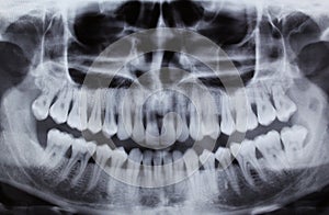 Dental Xray (x-ray)