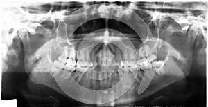 Dental Xray (x-ray)