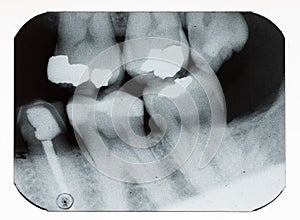 Dental xray photo