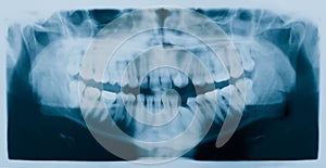 Dental Xray (x-ray) photo