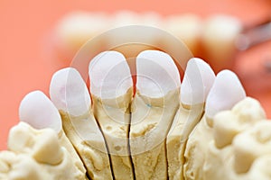Dental zircon / pressed ceramic photo