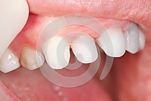 Zircon teeth photo