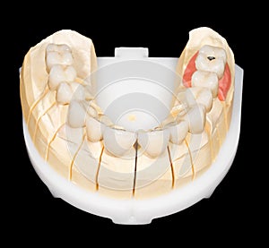 Dental zirconia bridge photo