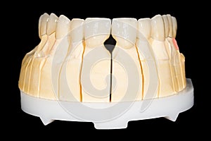 Dental zirconia bridge photo